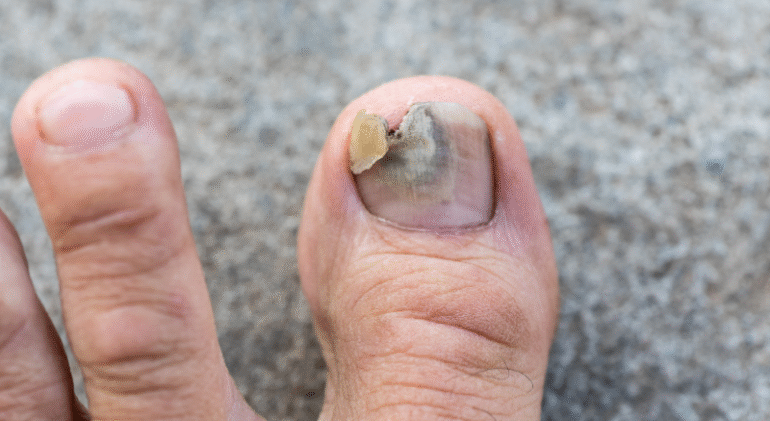 ayak mantarı tedavisi